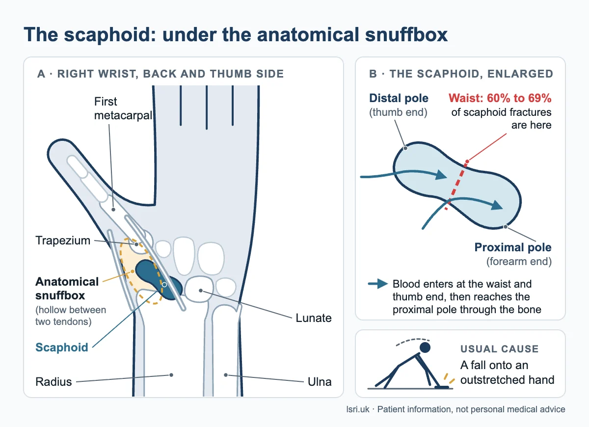 Where scaphoid fracture symptoms are felt: diagram of the right wrist with the scaphoid under the anatomical snuffbox, plus its waist, poles and blood supply