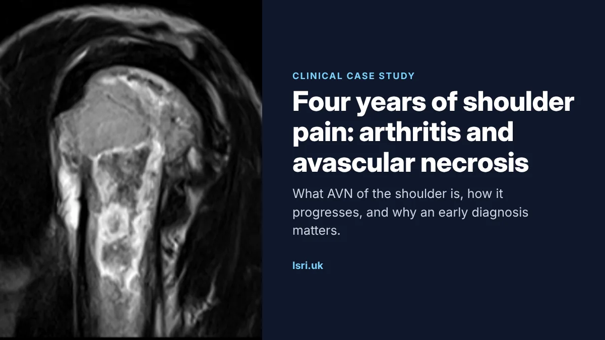 Four Years of Shoulder Pain: Osteoarthritis and Avascular Necrosis of the Shoulder