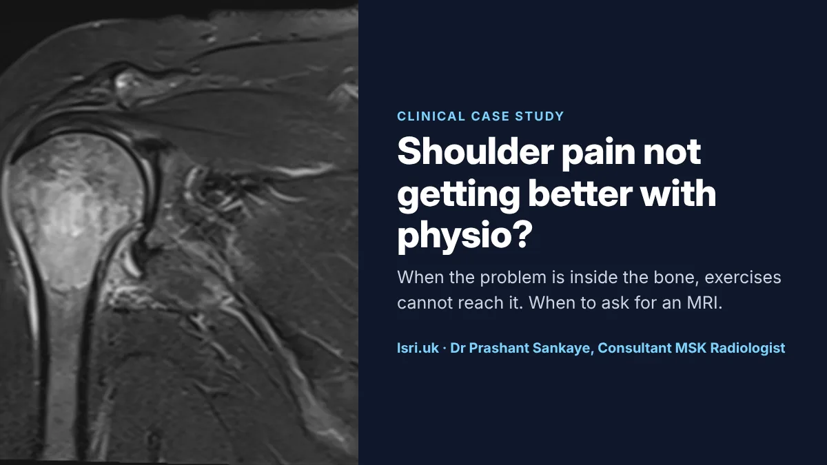 Shoulder Pain Not Getting Better With Physio? When You Need an MRI