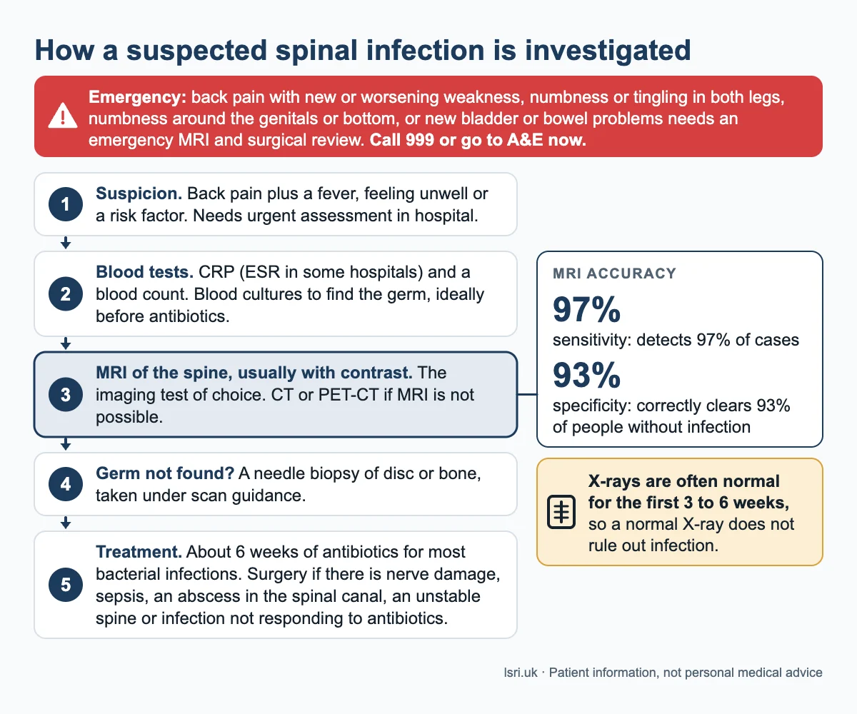 Pathway showing how a suspected spinal infection is investigated in hospital: blood tests and cultures, MRI of the spine, a needle biopsy if needed, then treatment