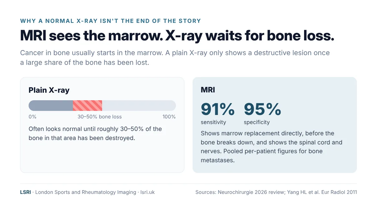 Spinal Metastases: Symptoms, Warning Signs and Why Early MRI Matters 2 Why a normal X-ray does not rule out spinal metastases: X-ray often looks normal until 30 to 50 percent of bone is lost, while MRI detects bone metastases with about 91 percent sensitivity and 95 percent specificity. LSRI guide reviewed by Dr Prashant Sankaye, Consultant MSK Radiologist